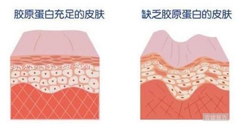 胶原蛋白有没有用 怎样补充 你想知道的都在这儿