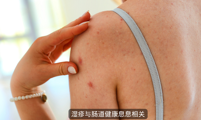 改善湿疹从肠道健康开始 补充益生菌 湿疹少上身