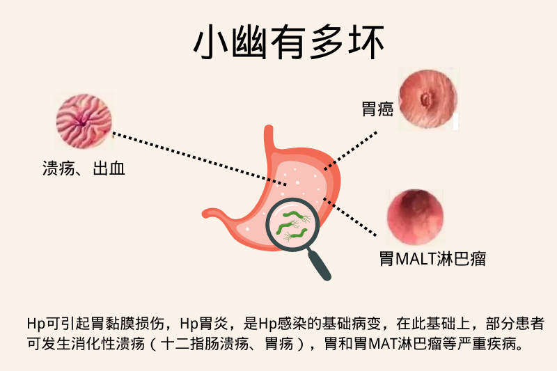 幽门螺旋杆菌小知识：原因、症状、治疗、预防