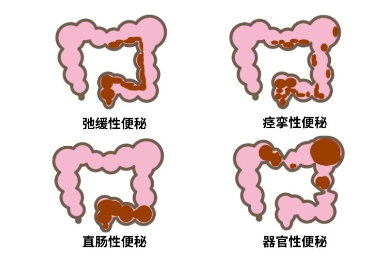 便秘怎么办？一文看清原因、危害及改善方法