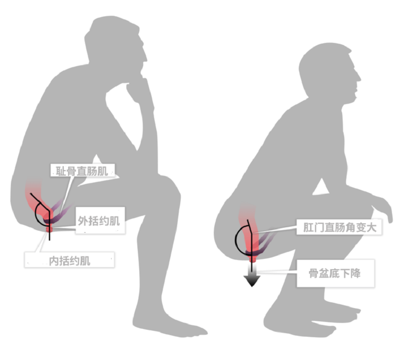 便秘怎么办？一文看清原因、危害及改善方法