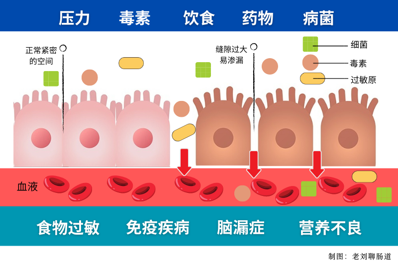 如何判断自己肠漏症，症状及治疗方法